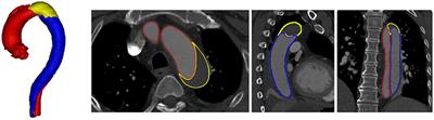 ImageTBAD: A 3D Computed Tomography Angiography Image Dataset for Automatic Segmentation of Type-B Aortic Dissection